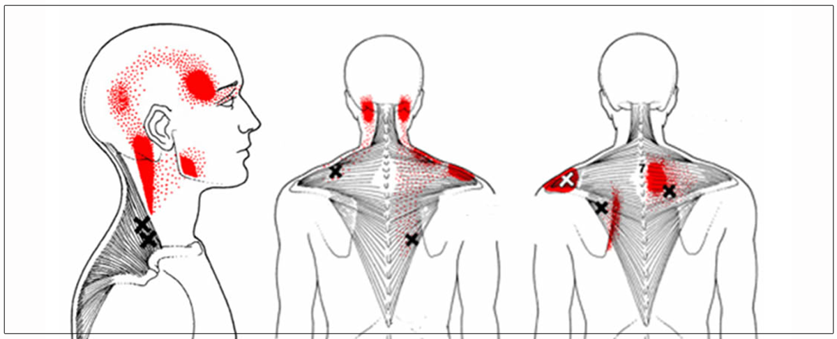 Olgularla Nörolojik Rehabilitasyon